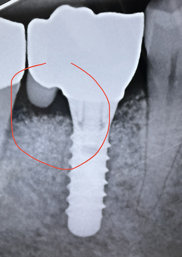 Neues Design bei Implantatkronen